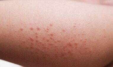 parasitoen presentzia gorputzean kanpoko adierazpenak